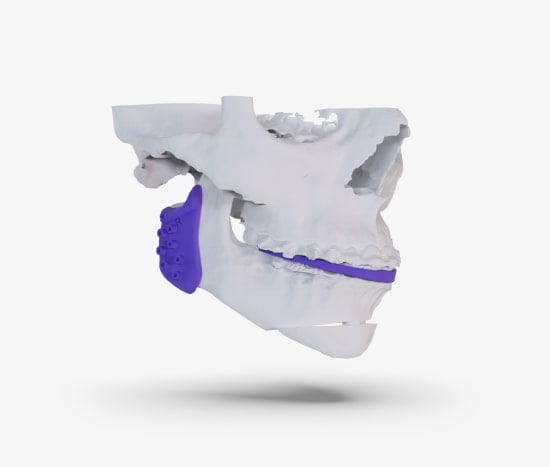 Guias cirúrgicos - Artfix Implants